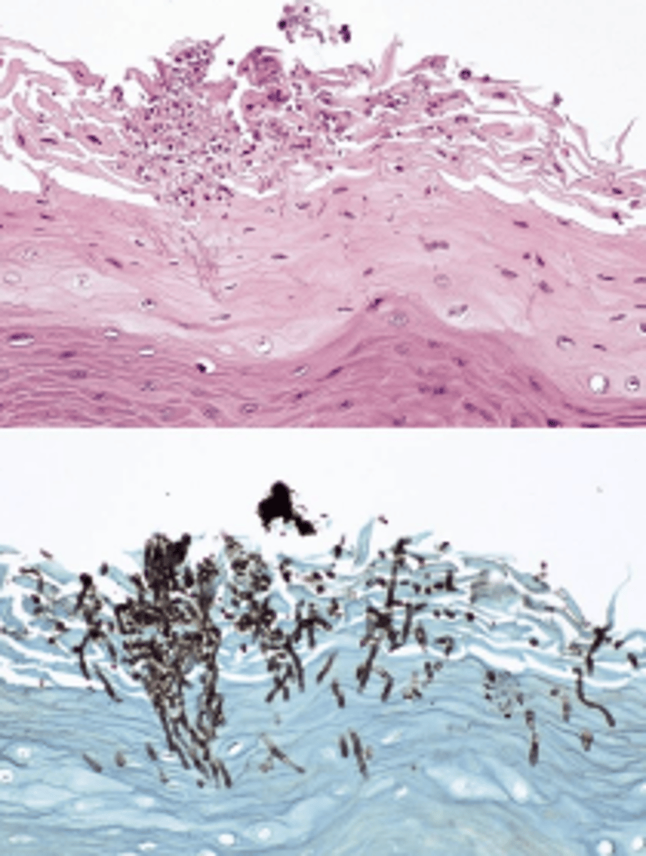 <p>- A superficial Candida albicans infection</p>