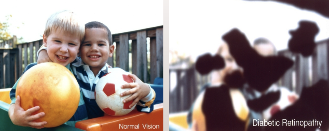 <p>complications of diabetes- too much sugar in blood damages retina - </p><p>floaters, loss of central vision, eye pain, blind spots, blurred vision</p>