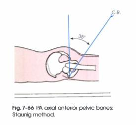 <p><span><strong>PP: </strong>Prone</span></p><p><span><strong>RP: </strong>Symphysis pubis</span></p><p><span><strong>CR: </strong>35o cephalad</span></p><p><span><strong>SS: </strong>Pelvic ring/inlet</span><br><span>• Anterior pubic &amp; ischial bones</span><br><span>• Symphysis pubis</span></p>