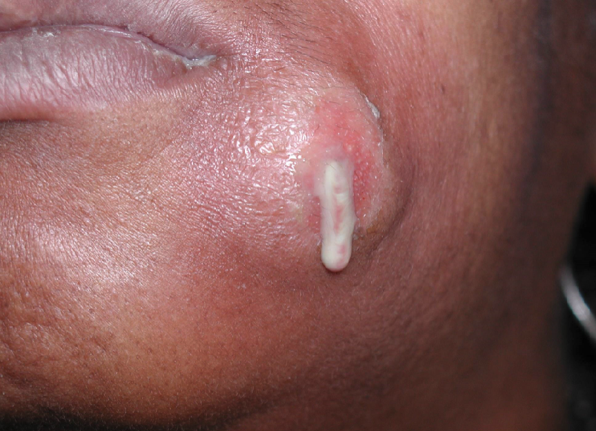 <ol><li><p>headache, fever, malaise, chills</p></li><li><p>tenderness of affected tooth </p></li><li><p>possibility to spread through bone (osteomyelitis) or perforate cortex + spread through soft tissue (cellulitis)</p></li></ol><p></p>