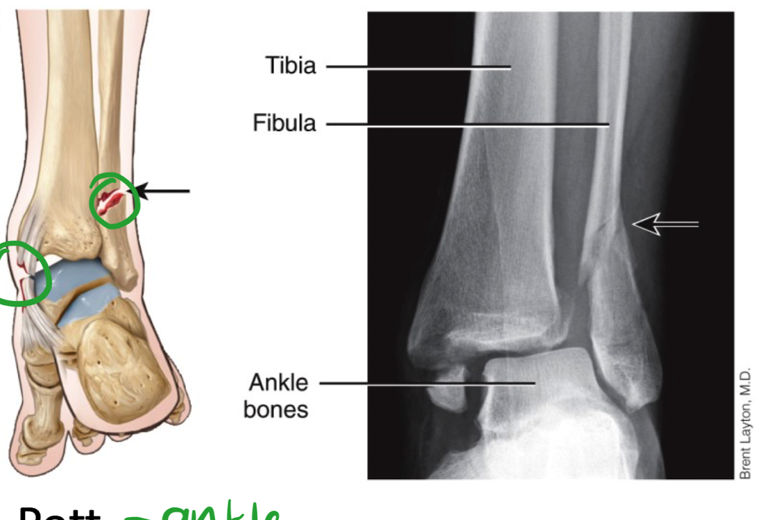 <ul><li><p>in the ankle </p></li><li><p>one of the malleoli (bump on ankle)</p><p></p></li></ul>