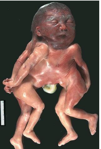 <p>conjoined twins at the head and chest</p>
