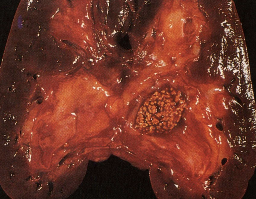 <p>Metastatic Calcification</p>