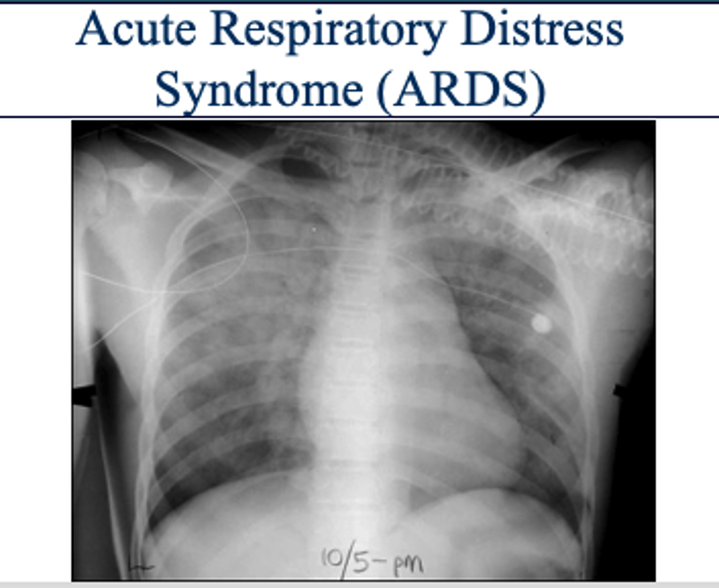 <p>"white out appearance" sometimes with sparing of costophrenic angles</p>