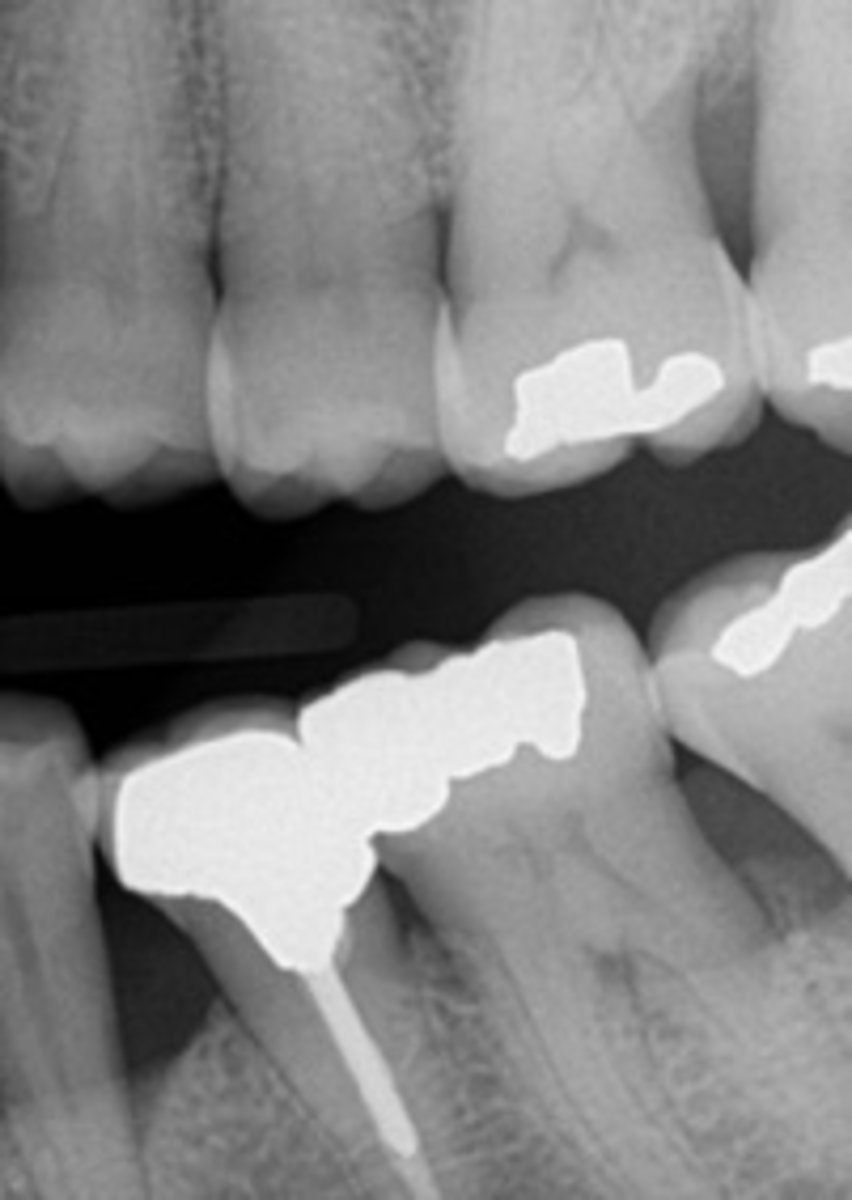 <p>The bitewing receptor is placed in the mouth with the long portion of the receptor in a vertical direction.</p>