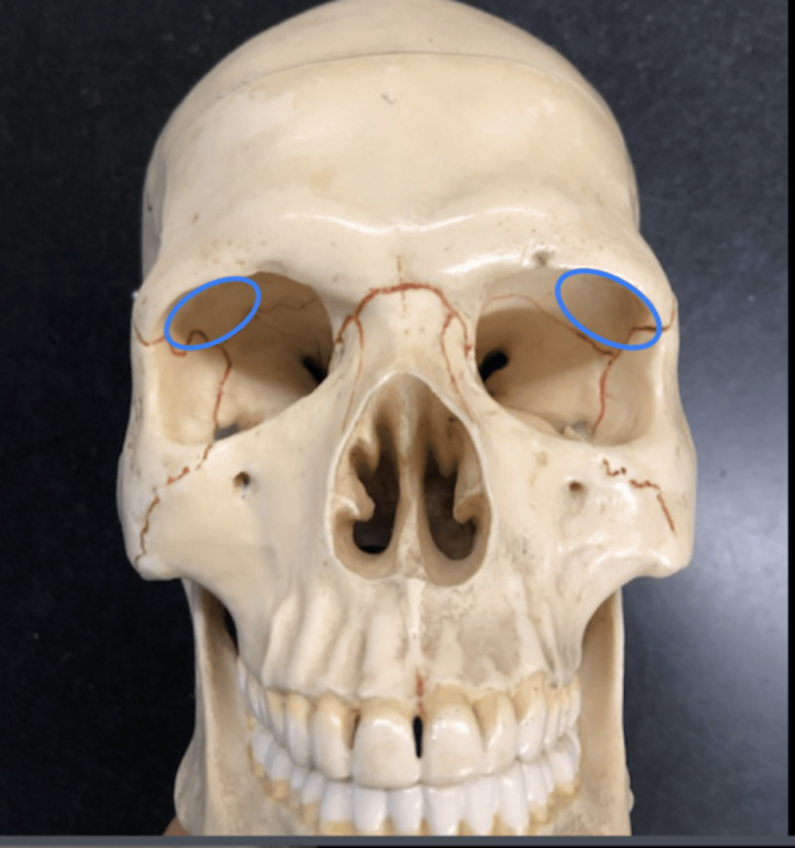 <p>Name this DEPRESSION</p><p>superior and lateral in the orbital socket</p>