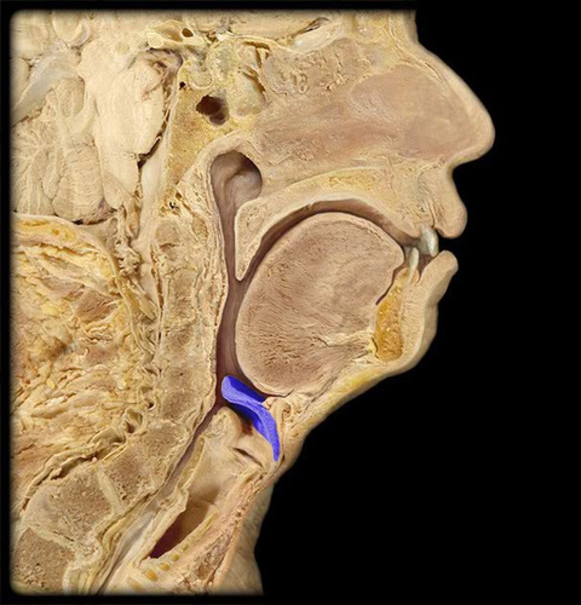 <p>A flap of tissue that covers the trachea during swallowing to prevent food from entering the airway.</p>