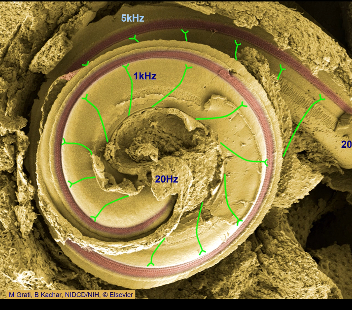 <p><span>•	Only ~3,500 inner hair cells per ear.</span></p><p class="p1"><span>•	Loud sounds cause excessive vibration → mechanical destruction.</span></p><p class="p1"><span>•	Excess glutamate at synapses can destroy afferents.</span></p><p class="p1"><span>•	Genetic conditions can eliminate hair cells.</span></p>