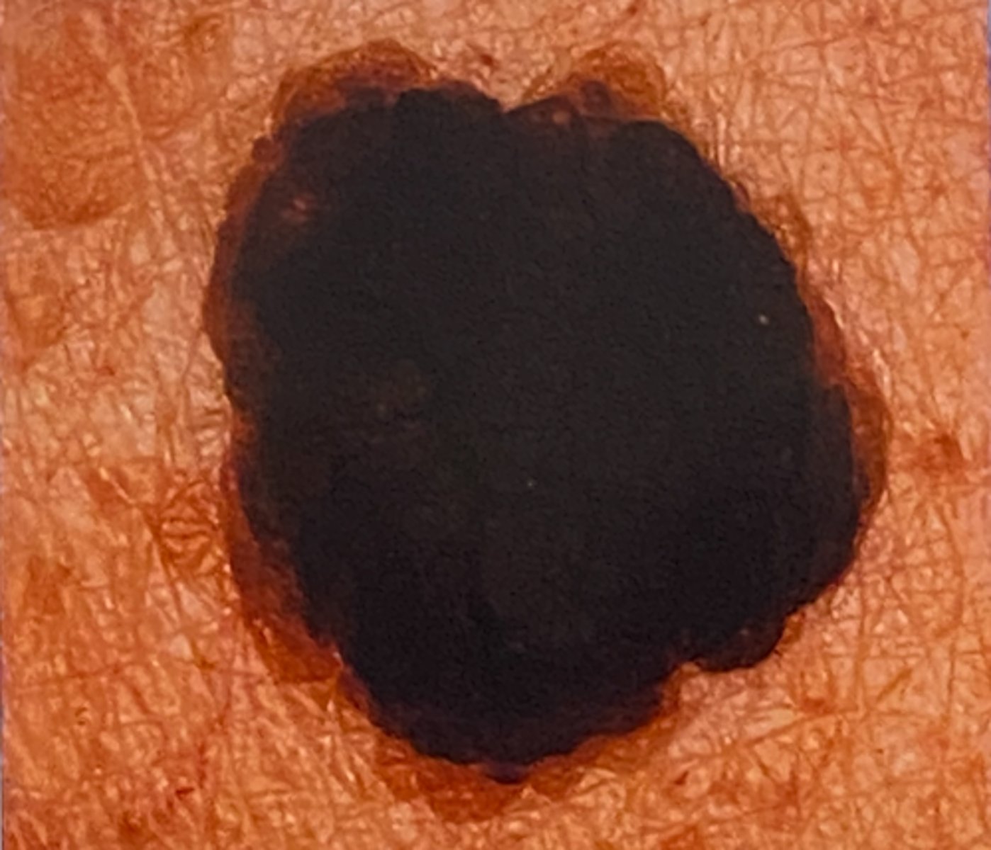 <p>Diagnosis:</p><p>-74-year-old female</p><p>-Admits to a long history of sun exposure</p><p>-CC: "This thing on my face is so ugly"</p>