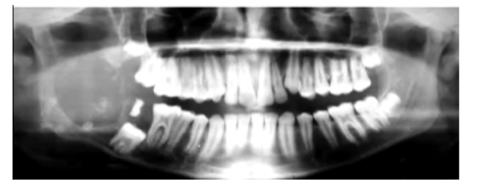 <p>Radiolucency with some calcifications. Tend to be well-outlined and large</p>