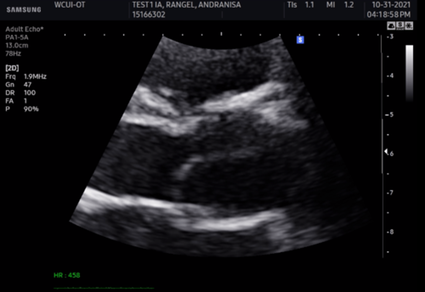 <p>Non coronary cusp</p>