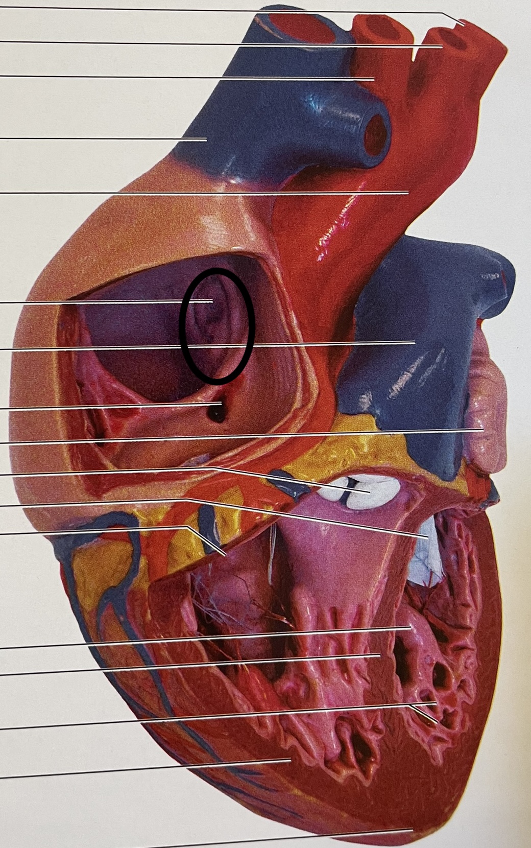 covered hole in interatrial septum