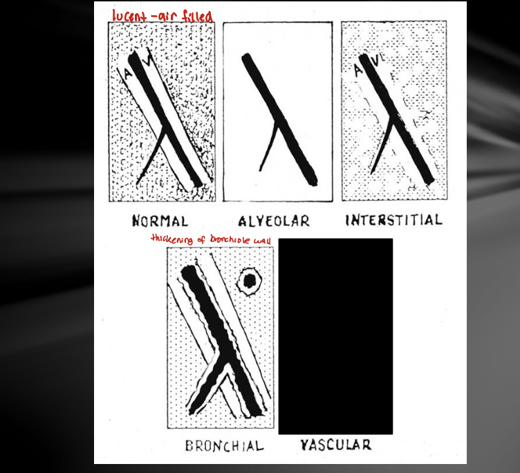 <ol><li><p>bronchial</p></li><li><p>interstitial</p><ol><li><p>structured - nodules</p></li><li><p>unstructured - diffuse + busy (blurry vessel)</p></li></ol></li><li><p>alveolar - all soft tissue opaque</p></li><li><p>(vascular)</p></li></ol><p></p>