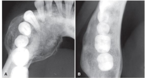 <p>time for new bone formation and expanded surface remains intact; suggests benign lesion </p>