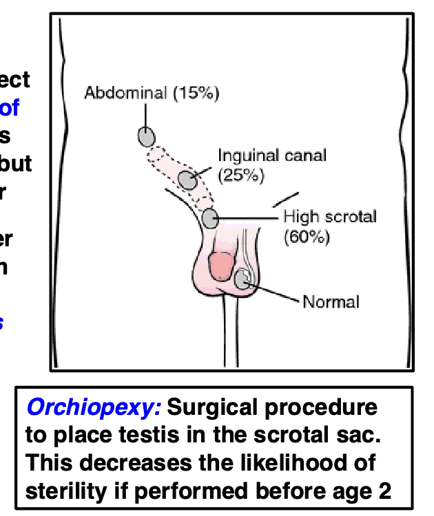 <ul><li><p>absence of one or both testicles from the scrotum</p></li><li><p><em>most common development defect in male GU tract</em></p><ul><li><p>affects over 3% of full-term newborns</p></li></ul></li><li><p>in most cases testes will descend by 3 months, but 1% are still undescended at 1 yr</p></li><li><p>sperm production requires a lower temp</p></li><li><p>testes descend from the abdomen into the scrotum in utero or shortly after birth</p><ul><li><p><em>testes not descended into scrotal sac greatly increases infertility</em></p></li></ul></li><li><p>increases risk of testicular cancer later in life </p></li></ul><p></p>