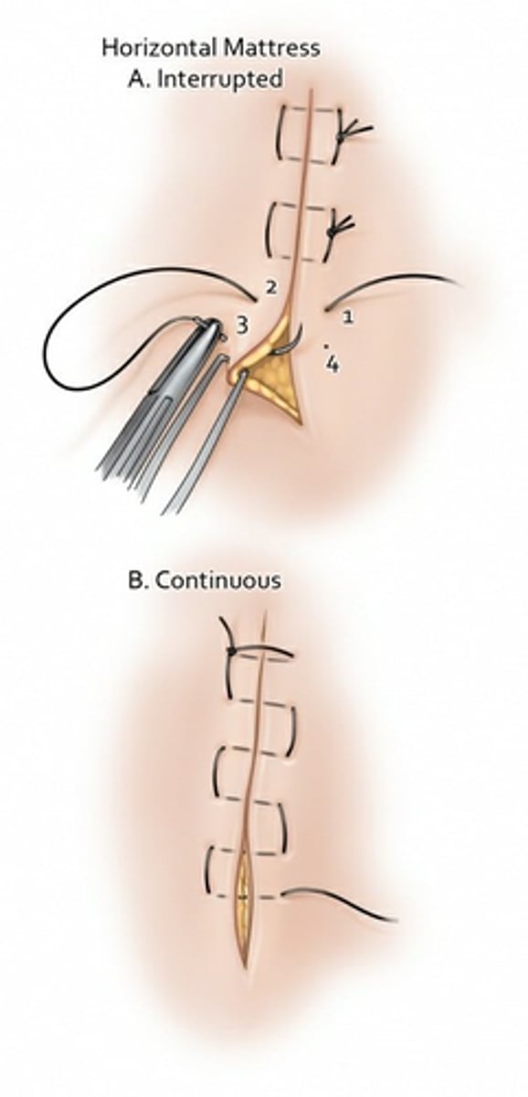 <p><span>This is done to evert the wound in high tension areas or if there is a flap of tissue</span></p>