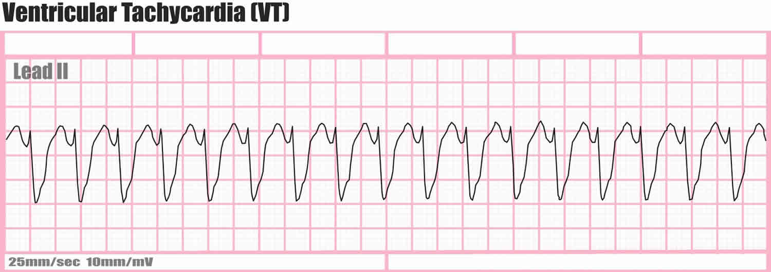 <p>Ventricular tachycardia (VT)</p>