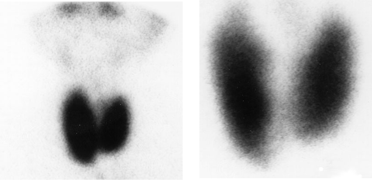 <p>The 24hr calculated uptake was 73%. What is your impression of this scan?</p>