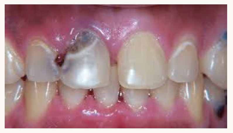 <p>what is this condition and what mineral is this person likely deficient in?</p>