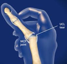 <ul><li><p><span>Etiology</span></p><ul><li><p><span>Sprain of UCL of MCP joint of thumb</span></p></li><li><p><span>Mechanism is forceful abduction of proximal phalanx occasionally combined with hyperextension.</span></p></li></ul></li><li><p><span>Signs and symptoms</span></p><ul><li><p><span>Pain over UCL in addition to weak and painful pinch</span></p></li></ul></li><li><p><span>Management</span></p><ul><li><p><span>Immediate follow up must occur</span></p></li><li><p><span>Thumb splint should be applied for protection for 3 weeks</span></p></li><li><p><span>Splint should extend from wrist to end of thumb in natural position&nbsp;</span></p></li><li><p><span>Surgery may be required</span></p></li></ul></li></ul><p></p>