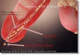 <p>inflammation of urethra </p><p>caused by : trachomatous &amp; mycoplasma gentium</p><p>Symptoms : painfil urination &amp; water discarge </p><p>can develop into PID  </p>