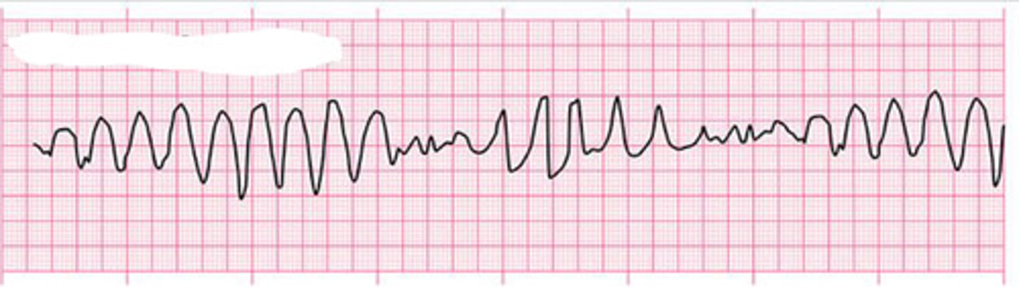 <p>What arrhythmia is this?</p>