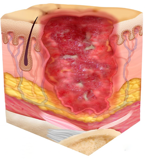 <p>Using the image provided, identify the stage of the pressure injury: A. Stage 1 pressure injury B. Stage 2 pressure injury C. Stage 3 pressure injury D. Stage 4 pressure injury E. Unstageable pressure injury</p>