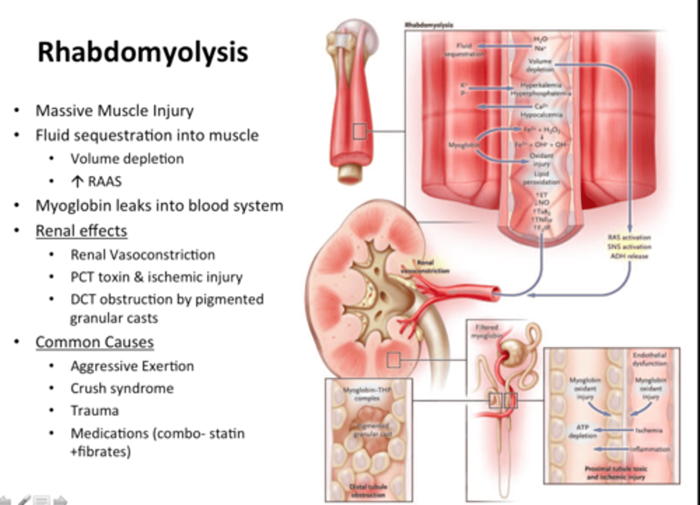 <p>rhabdomyolysis</p>