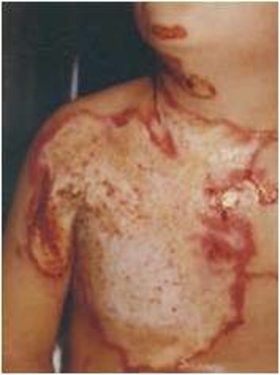 <p>what type of burn is this describing?</p><p>waxy, leathery and lifeless, +- charring</p><p>death of all skin layers, including sweat glands, hair follicles, and nerve endings</p>