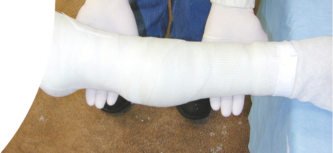 <ul><li><p>Foot cast, Lower limb cast, Full limb cast, Tube cast (sleeve cast)</p></li><li><p><span>Normally applied under general anesthesia</span></p></li></ul><p></p>