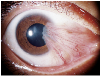 <p>Describe these ABNORMAL findings (Assume OD)</p>