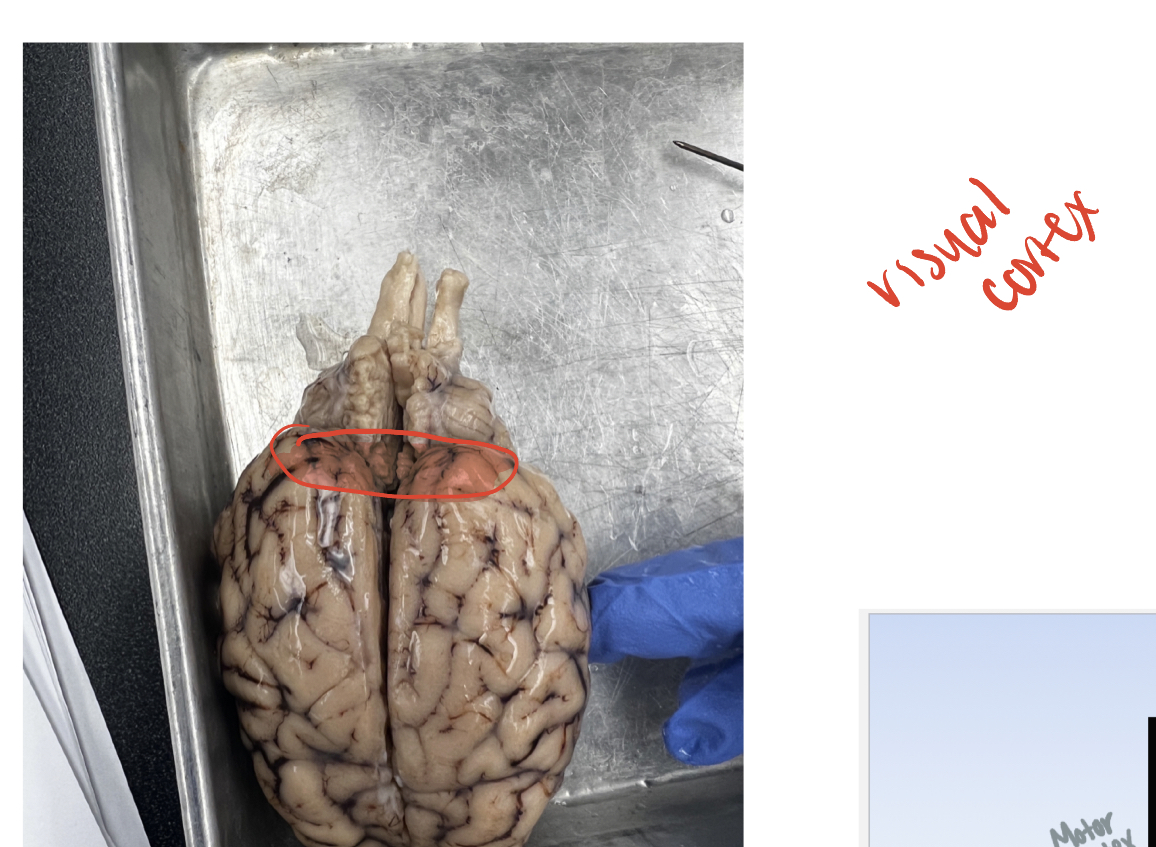 <p>(G) in occipital lobe, the most posterior portion. complex visual processing </p>