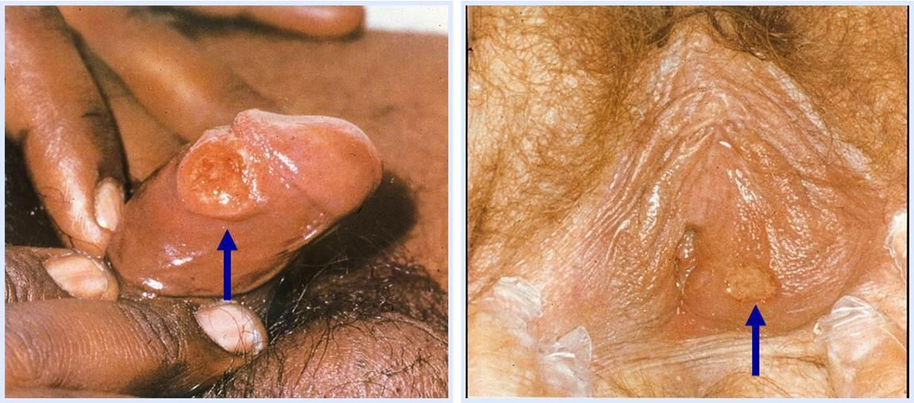 <p>Syphilis </p>