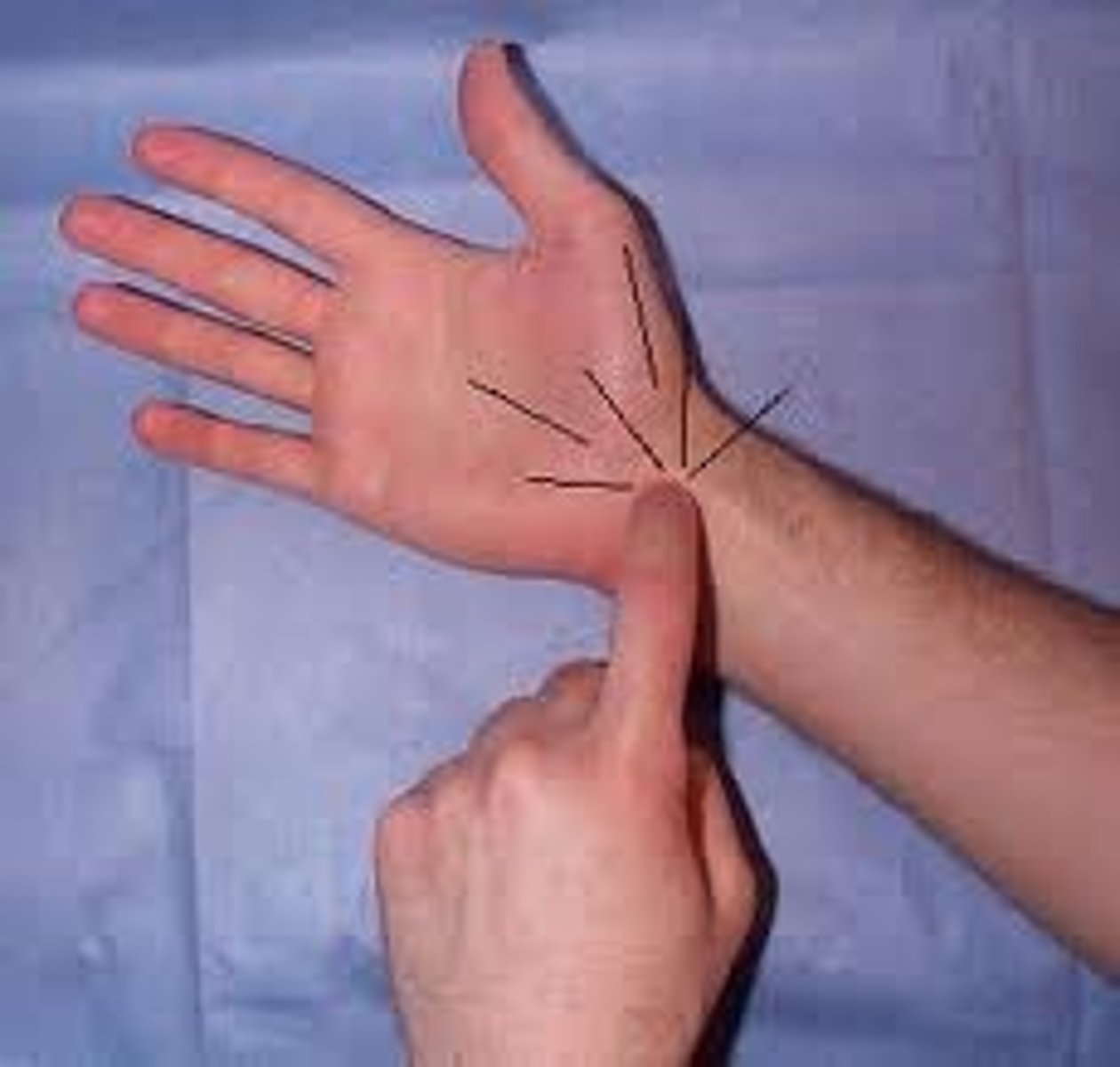 <p>- diagnosis: median nerve compression (carpal tunnel)</p><p>+ = reproduction of symptoms</p>