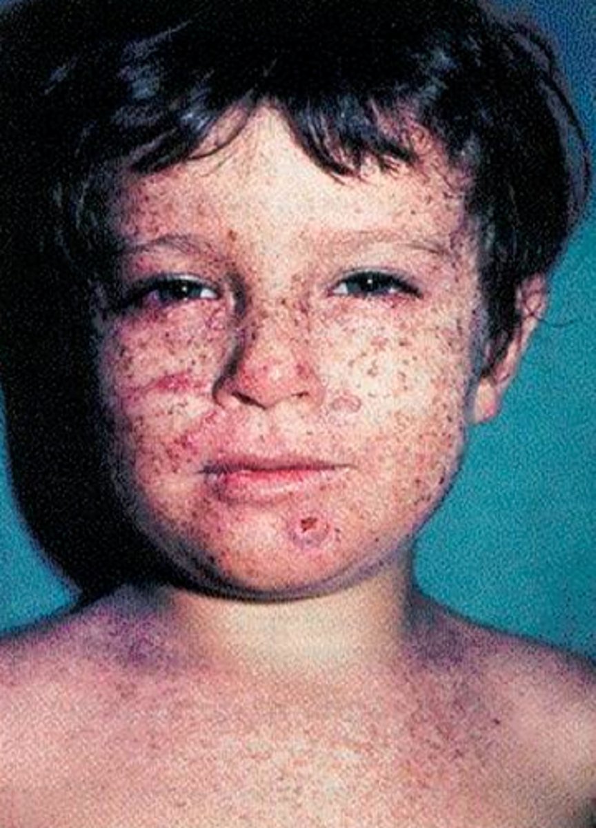 <p>•Inherited condition<br>•<br>•Extreme sensitivity to UV rays from sunlight<br>•<br>•Sun exposure causes dry skin and changes in skin pigment<br><br>•Greatly increased risk of developing skin cancer</p>