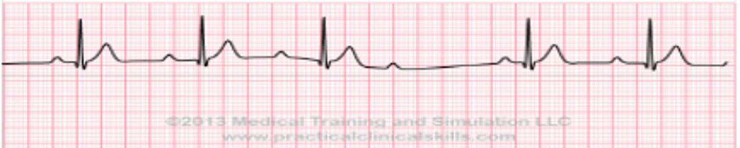 <p>heart block where the PR segment gradually lengthens until the QRS fails to appear (non-conducted P-Wave)</p>