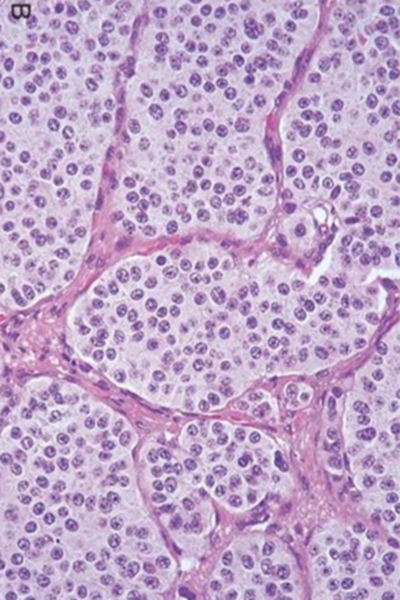 <p>Carcinoid syndrome</p><p>(right-sided cardiac valvular fibrous lesions, Increased 5-HIAA in urine, 5-HT in serum)</p><p>Requires mets from GI to liver</p>