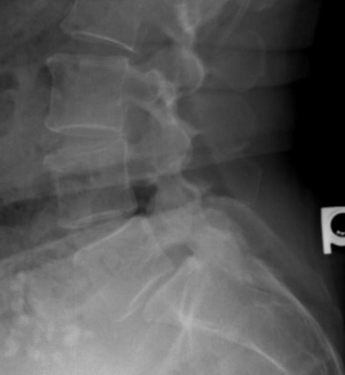 <p>What type of spondy is this?</p>