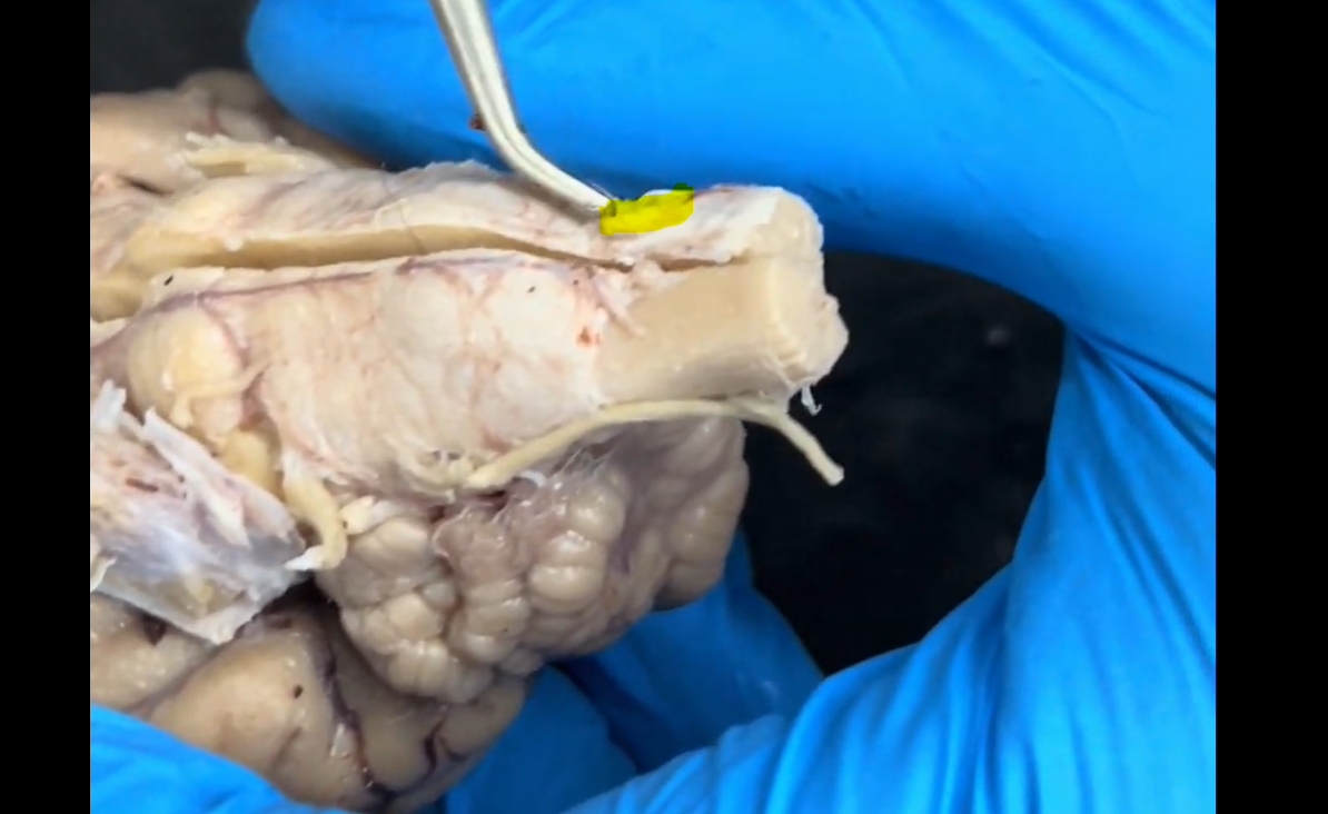 <p>Name the part of the brain at the tip of the probe and highlighted in yellow.</p>