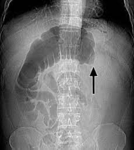 <p>Massive accumulation of gas proximal to obstruction</p><p>Absence of gas distal to obstruction</p><p>High risk of bowel perforation</p>