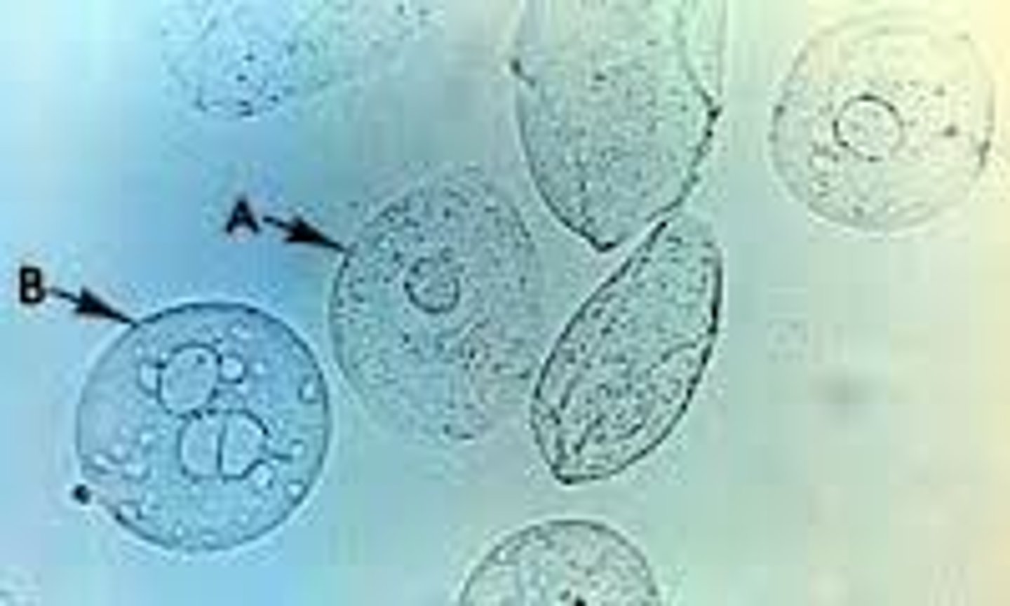 <p>They are smaller than their squamous counterparts and can be either spherical, polyhedral and caudate</p><p>- The change in size is due to the amount of water that is absorbed by the cells. The more water the more spherical they look. They have a very large CENTRALLY located nuclei.</p><p>- Increased number of transitional cells (singly or in pairs/clumps) is called SYNCYTIA and is present following invasive urologic procedures such as catheterization and are of NO clinical significance</p><p>- Abnormal morphology (vacuoles and irregular nuclei) indicate malignancy or viral infection</p>