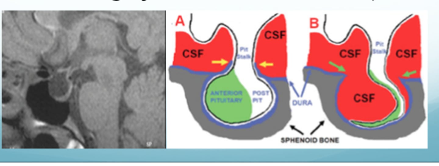 <p>subarachnoid space extends into the sella turcica</p>