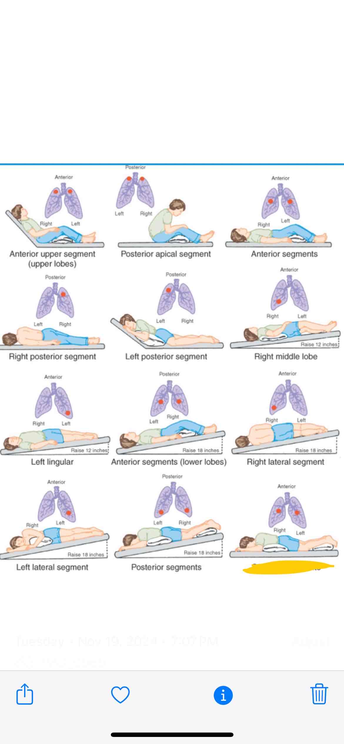 <p><span>Which lung segment does this position effect</span></p>