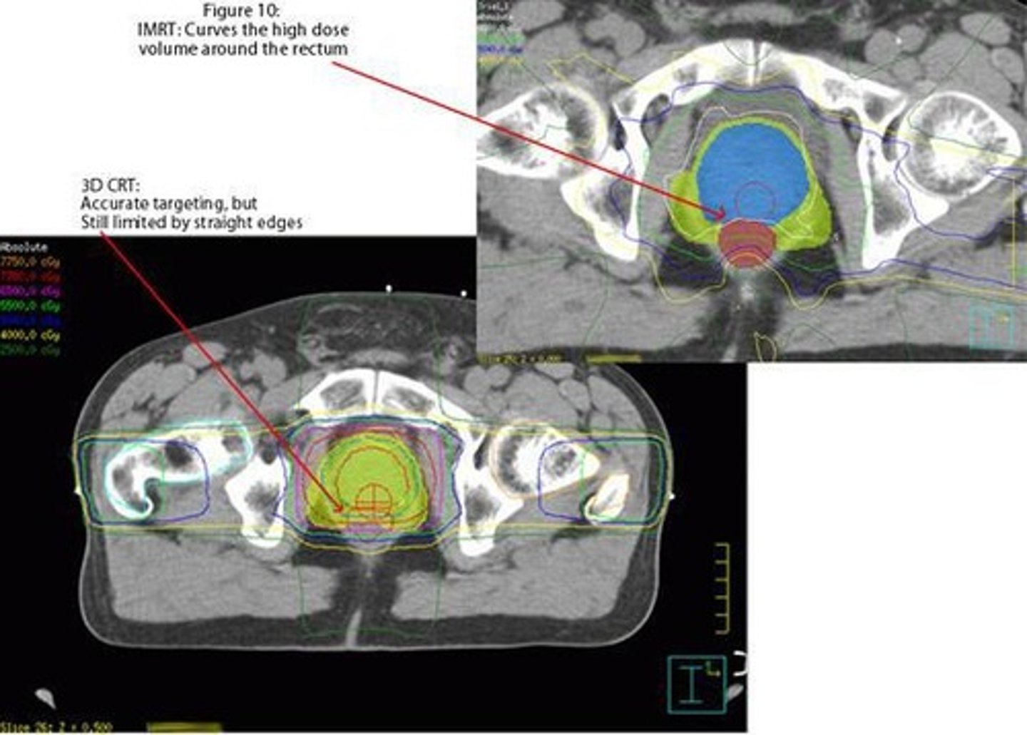 <p>Non-IMRT uses open fields with customized MLCs, while IMRT delivers radiation in a non-uniform manner to better spare critical structures.</p>