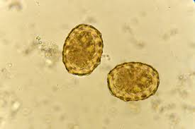 <p>The egg shown below was detected in a preemployment stool specimen submitted by a kitchen worker who has never traveled outside the United States. He denied symptoms of gastrointestinal illness. Identify the parasite.<br><br></p><p>ylostoma duodenale</p><p>Ascaris lumbriocoides</p><p>Enterobius vermicularis</p><p>Fasciola hepatica</p><p>Paragonimus westermani</p>