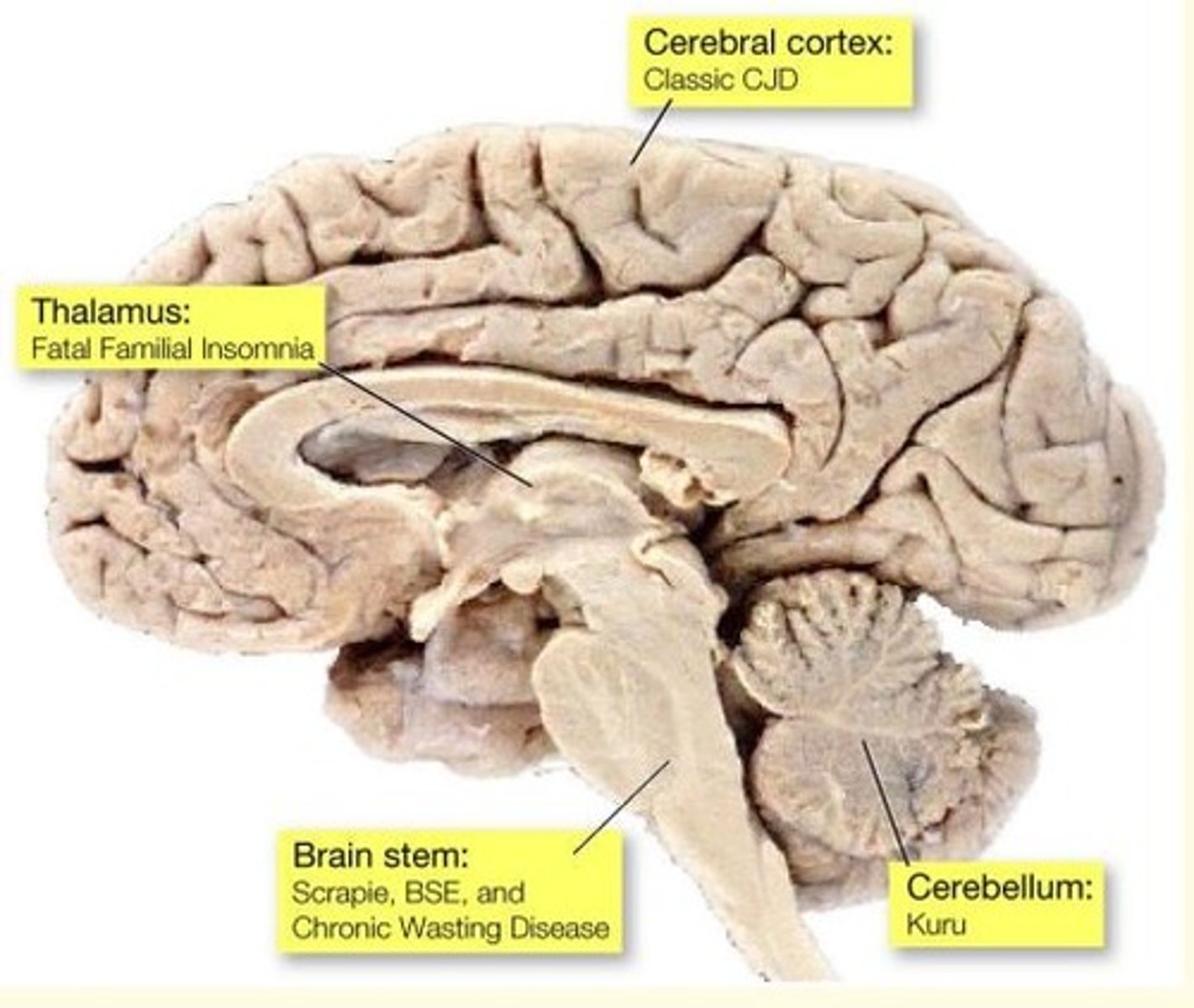 <p>Fatal Familial Insomnia</p>