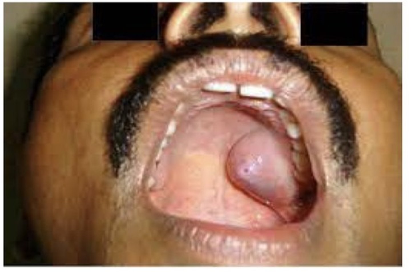 <p>A benign salivary gland tumour. 90% of all salivary gland tumours. The most common extraoral location is the parotid gland; the most common intraoral location is the palate. Clinically appears as a slowly enlarging, non-ulcerated, painless, dome shaped mass. Tx: surgical excision, recurrence rates vary, they are related to the success of the initial surgical removal. Lesions are known to undergo malignant transformation.</p>
