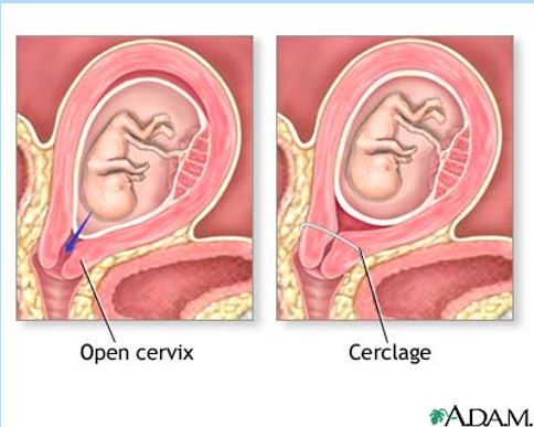 <ul><li><p><strong>Close observation with ultrasound for cervical thinning</strong></p></li><li><p><strong>Cerclage</strong>:</p><ul><li><p>Like tying a string early in pregnancy around the cervix to provide support so it doesn’t dilate too early; closer to delivery, around 37 to 38 weeks, the doctor will cut the string.</p></li></ul></li><li><p><strong>Tocolytics</strong></p></li><li><p><strong>Broad-spectrum antibiotics</strong>—due to mom being at increased risk for infection from cerclage.</p></li></ul><p></p>