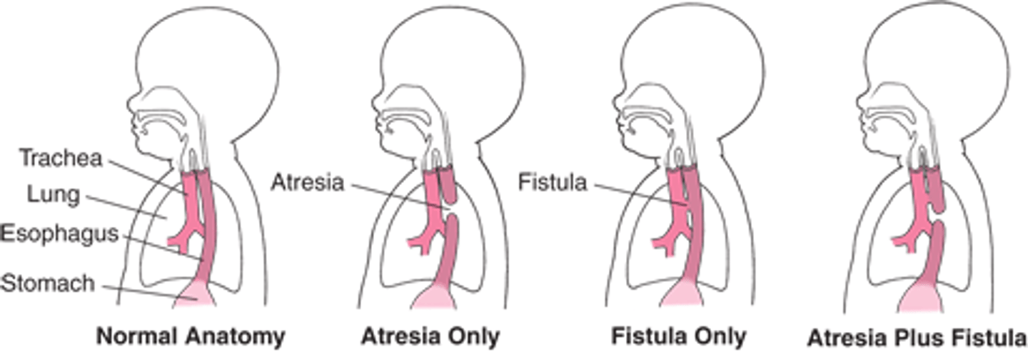 <p>Define Condition:</p><p>Congenital defect where the esophagus is closed at the bottom where it’s supposed to connect to the stomach</p><p>-Hx: A/w fistula connecting upper or lower esophageal pouches to bronchus or trachea</p><p>-Path: MC near Tracheal Bifurcation</p><p>-Dx: Type C (TEF-EA) is MC</p><p>-Prog:</p><p>&gt; Aspiration</p><p>&gt; Suffocation</p><p>&gt; Pneumonia</p><p>&gt; Fluid/Electrolye Imbalance</p>