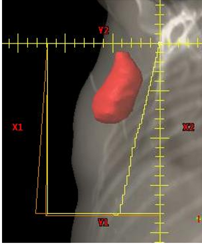 <p>what treatment technique is often added to the tangent fields to boost certain parts of the field while keeping other parts of the initial field colder?</p>